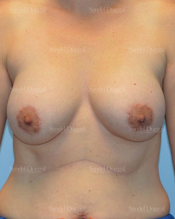 Breast Augmentation with Lift after, case 3456