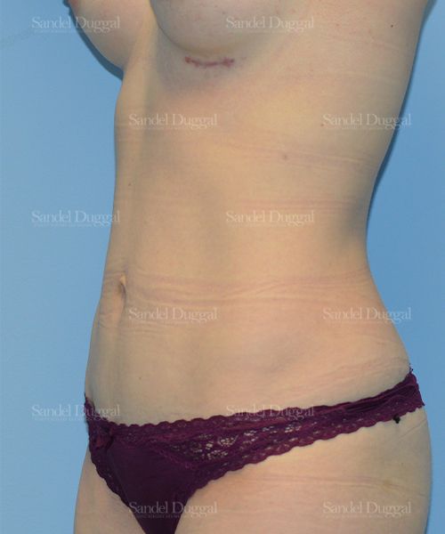 Tummy Tuck after, case 1554