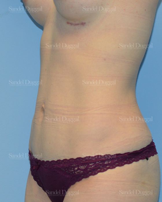 Tummy Tuck after, case 1554