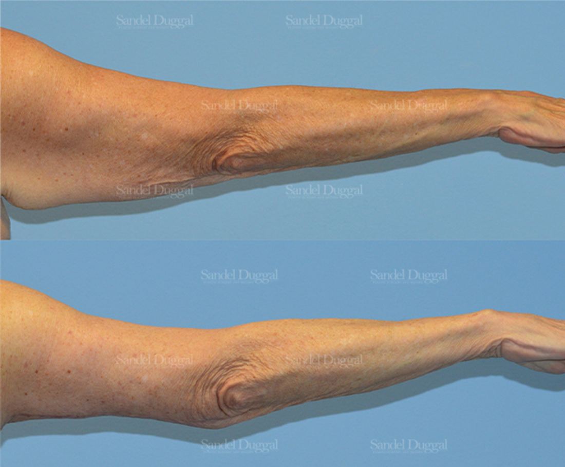 Brachioplasty before and after, case 2144