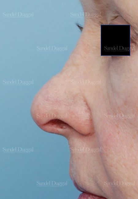 Revision Rhinoplasty before, case 2614