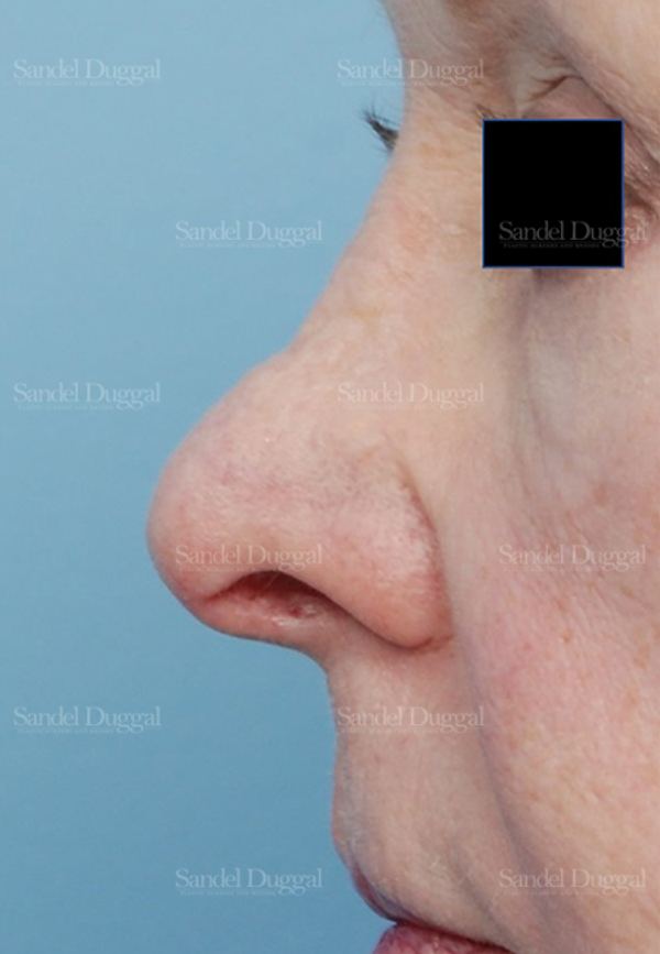 Revision Rhinoplasty before, case 2614