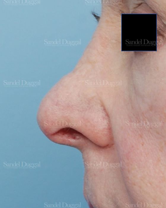 Revision Rhinoplasty before, case 2614