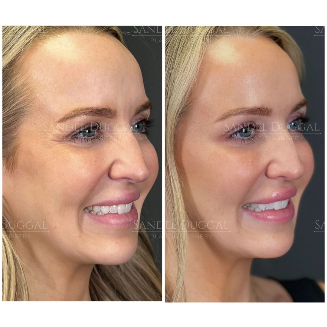 Botox & Fillers before and after, case 6011
