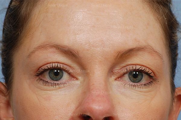 Botox & Fillers after, case 845