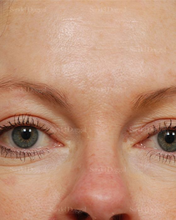 Botox & Fillers after, case 845