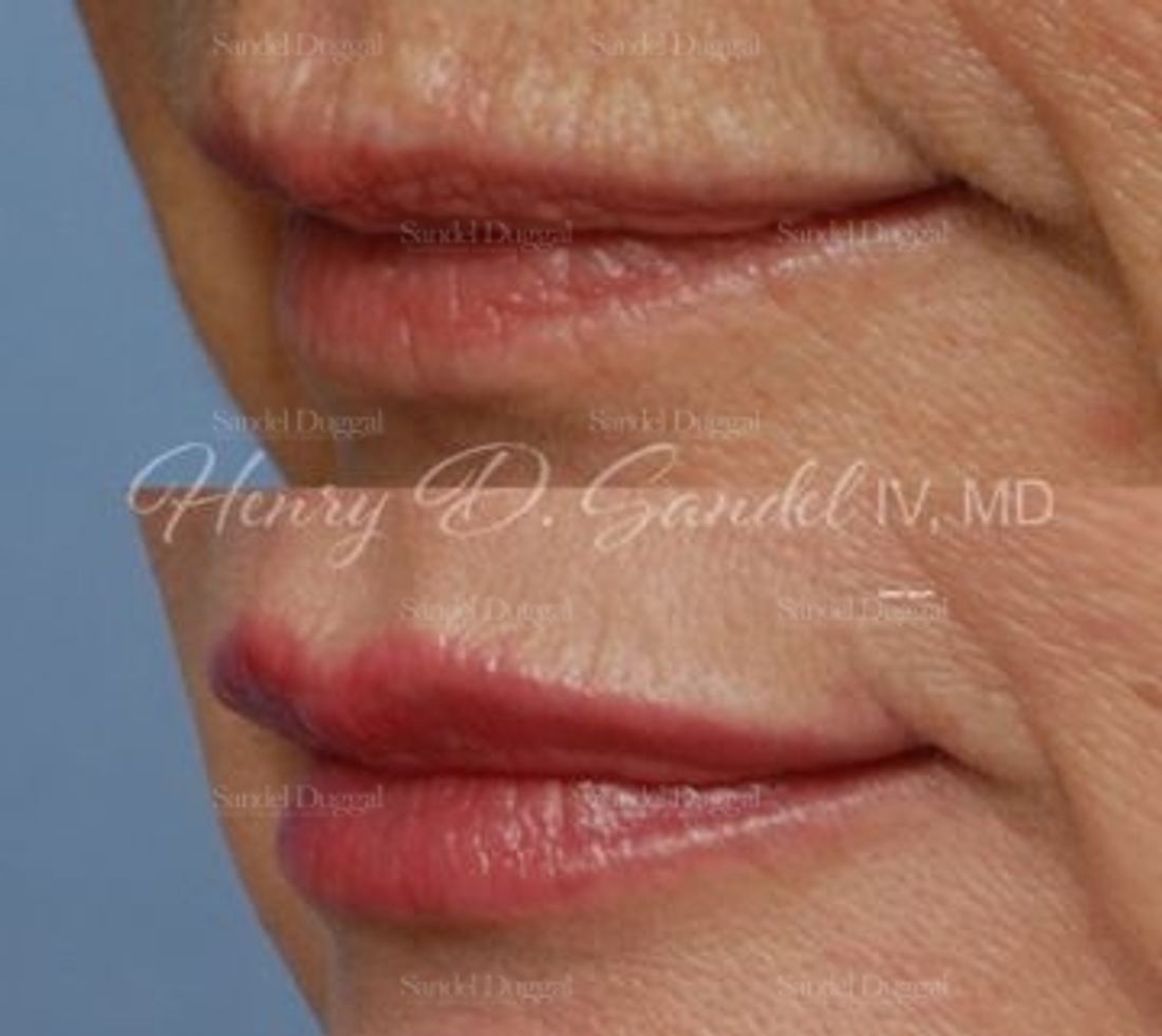 Lip Augmentation / Lip Lift before and after, case 4395