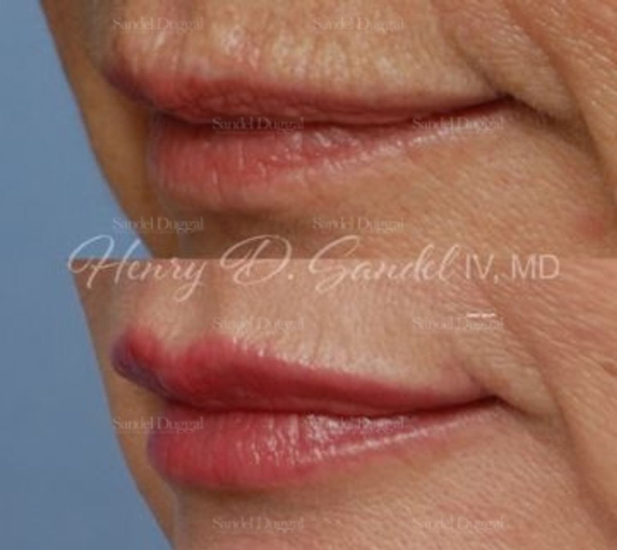 Lip Augmentation / Lip Lift before and after, case 4395