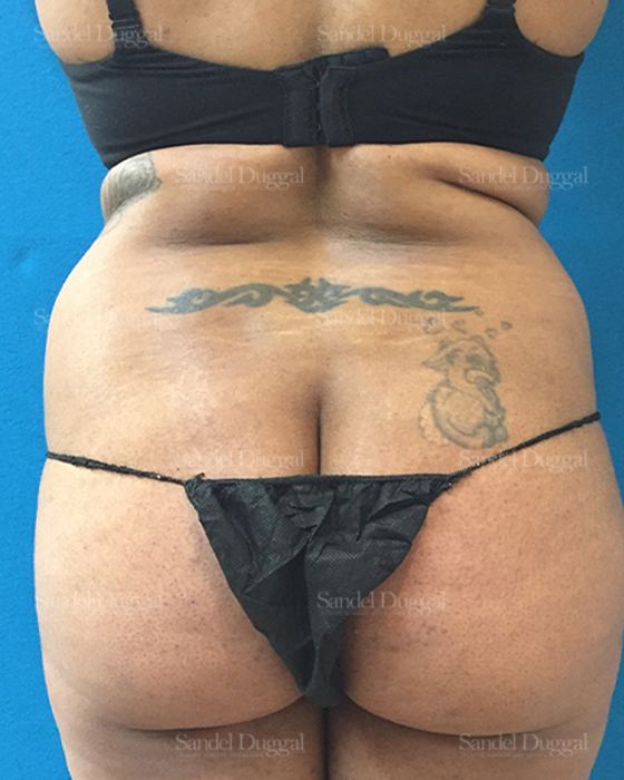 Liposuction — Legs & Flanks before, case 2504