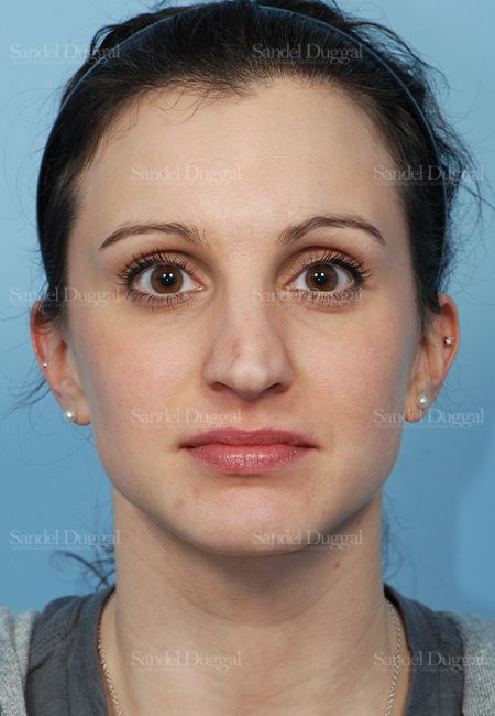 Rhinoplasty before, case 2831