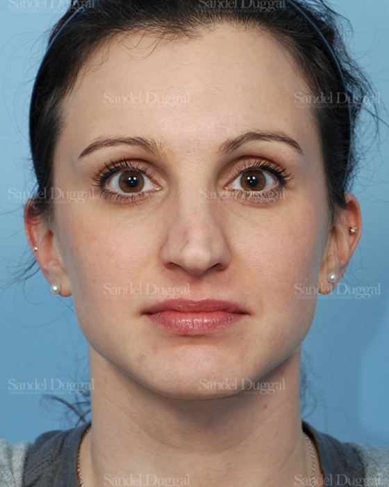 Rhinoplasty before, case 2831