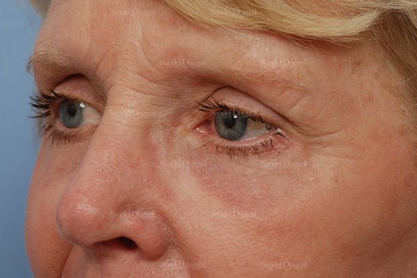 Eyelid Rejuvenation after, case 1946
