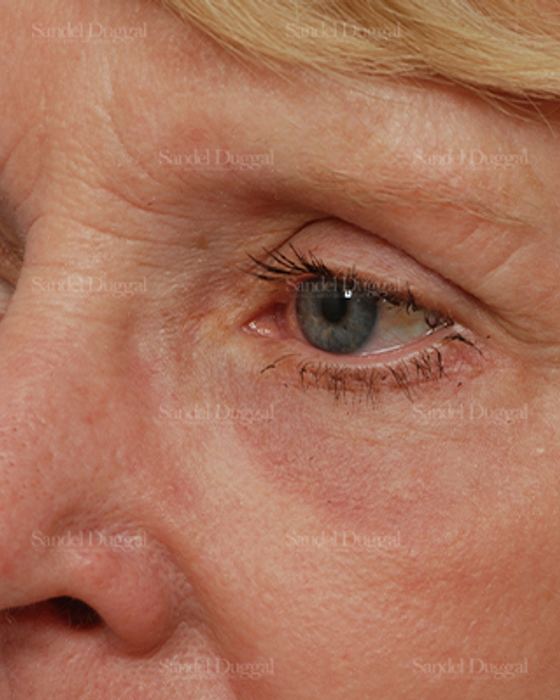 Eyelid Rejuvenation after, case 1946
