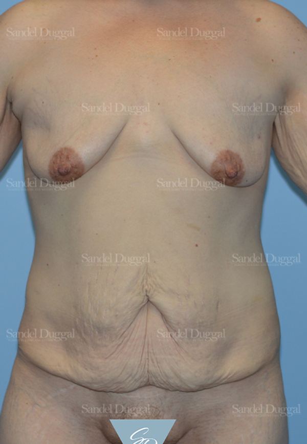 Mommy Makeover before, case 2211