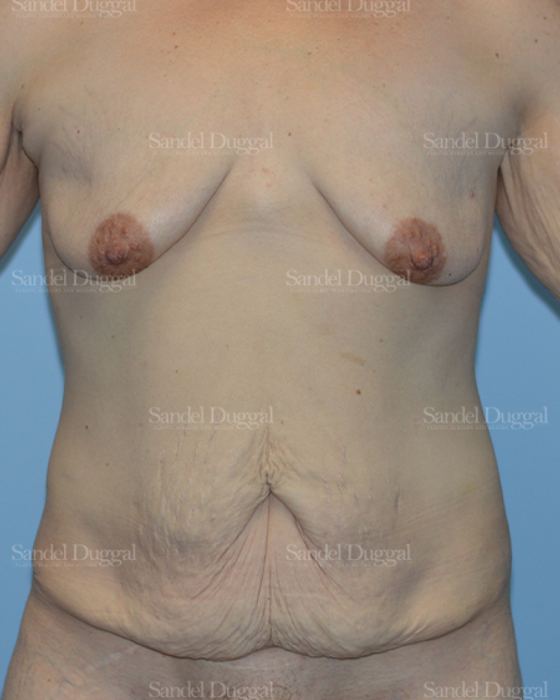 Mommy Makeover before, case 2211