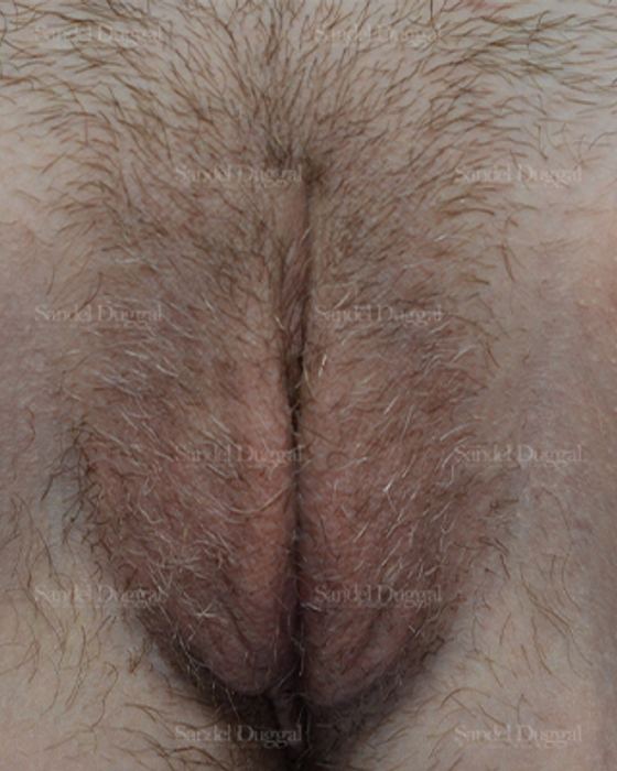 Labiaplasty after, case 3033