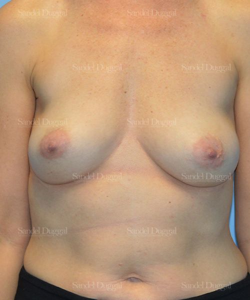 Breast Augmentation before, case 3108