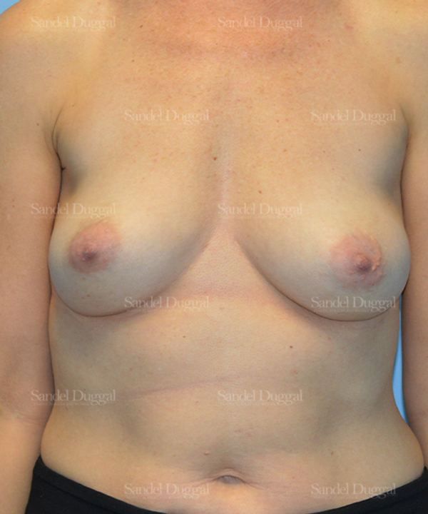 Breast Augmentation before, case 3108