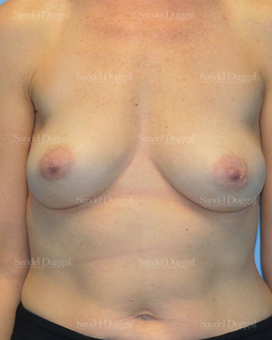 Breast Augmentation before, case 3108