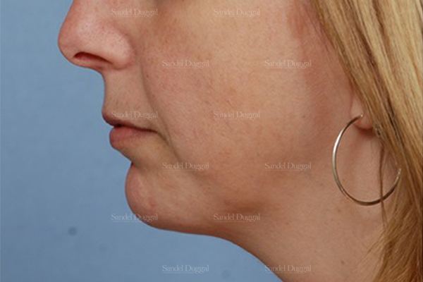 Chin Augmentation after, case 1474