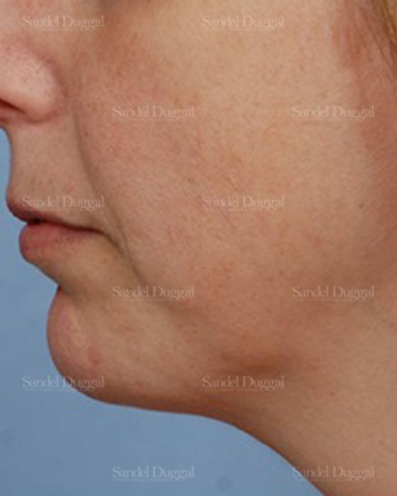 Chin Augmentation after, case 1474