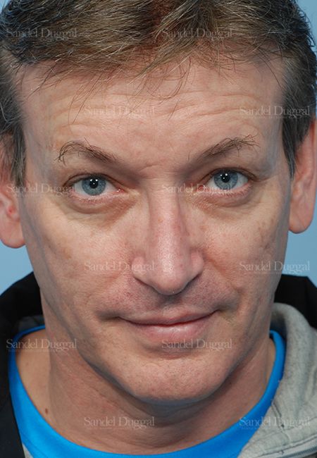 Rhinoplasty after, case 2838