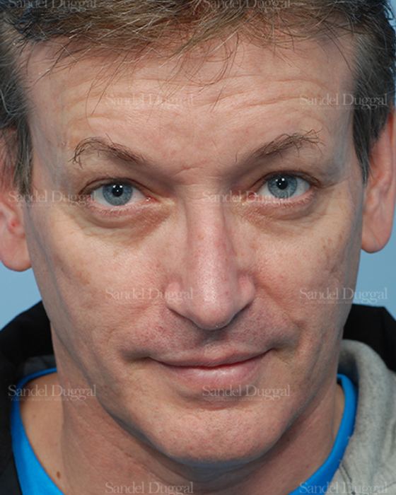 Rhinoplasty after, case 2838