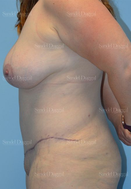 Mommy Makeover after, case 2190