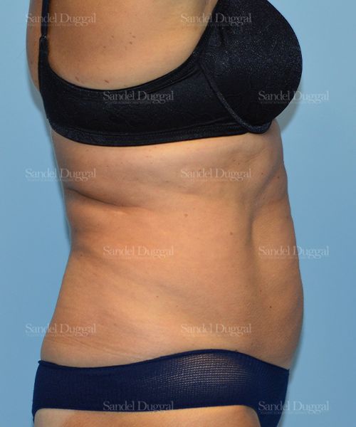 Tummy Tuck before, case 1636