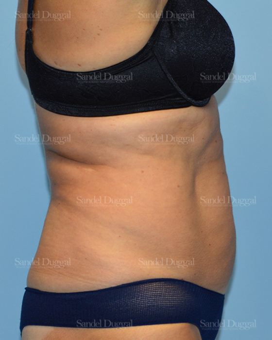 Tummy Tuck before, case 1636