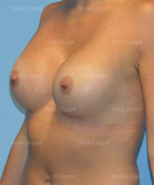 Breast Augmentation after, case 3171