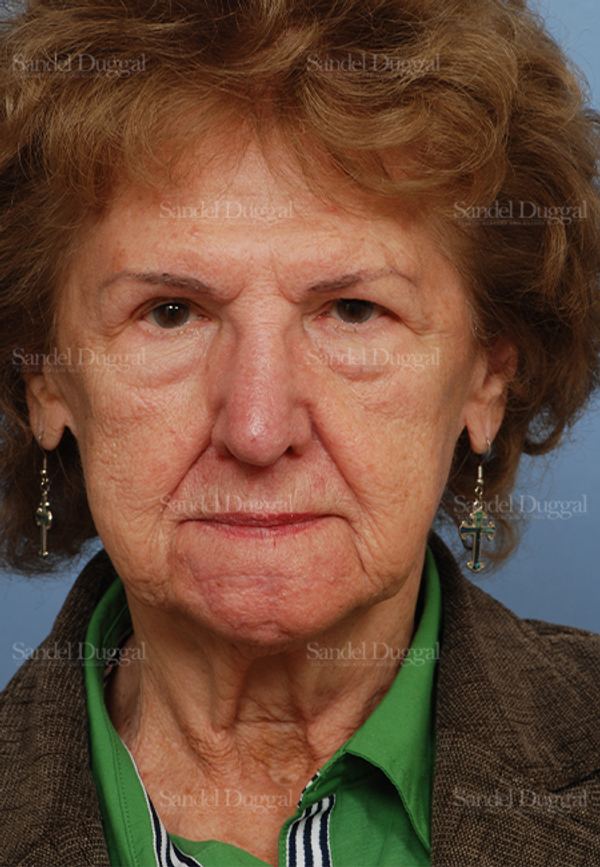 Reconstruction after Mohs after, case 2730