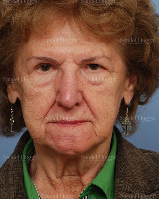 Reconstruction after Mohs after, case 2730