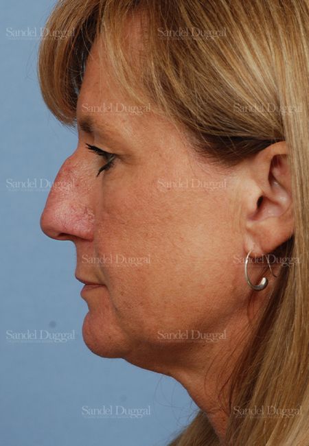 Rhinoplasty before, case 2918