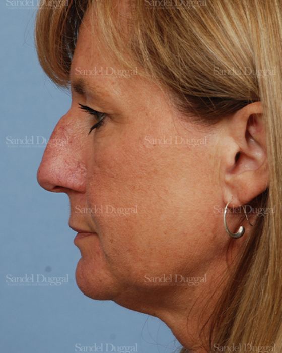 Rhinoplasty before, case 2918