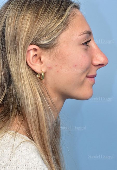 Rhinoplasty after, case 5375