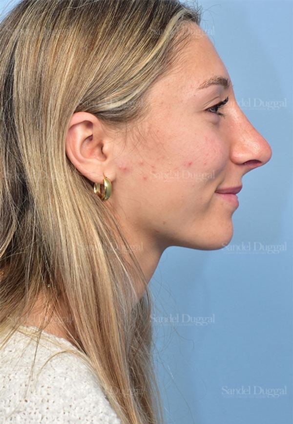 Rhinoplasty after, case 5375
