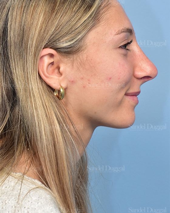 Rhinoplasty after, case 5375