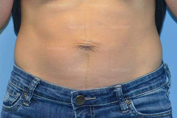 Umbilicoplasty before, case 1457