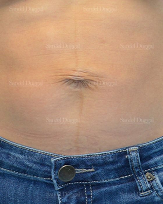 Umbilicoplasty before, case 1457