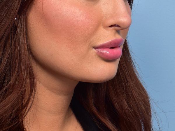 Buccal Fat Reduction after, case 6005
