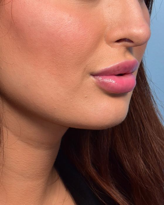 Buccal Fat Reduction after, case 6005