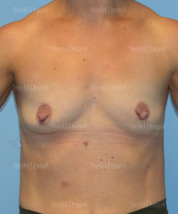 Breast Augmentation before, case 3115