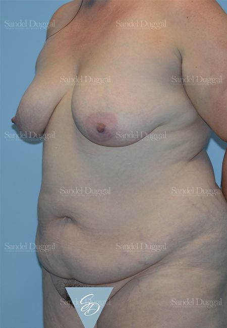 Mommy Makeover before, case 2190