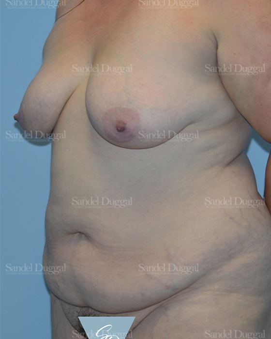 Mommy Makeover before, case 2190