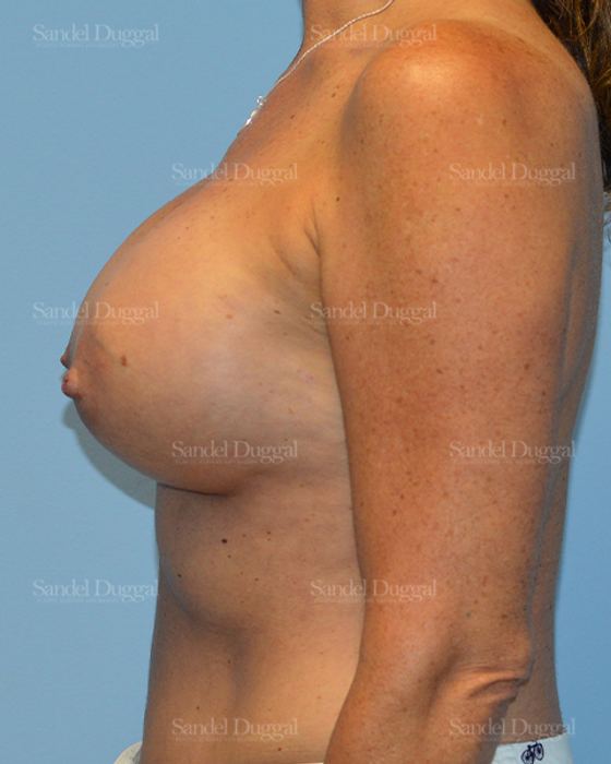Breast Augmentation after, case 3185
