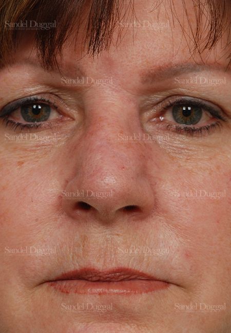 Reconstruction after Mohs after, case 2811