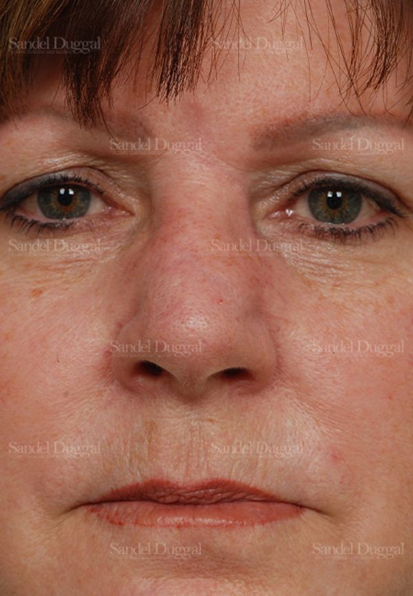 Reconstruction after Mohs after, case 2811