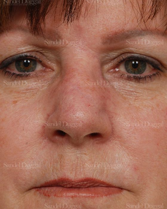 Reconstruction after Mohs after, case 2811