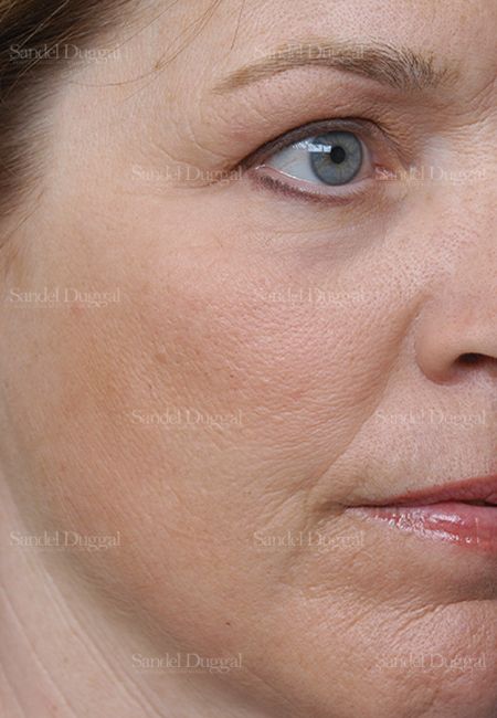 Laser Skin Resurfacing after, case 2981